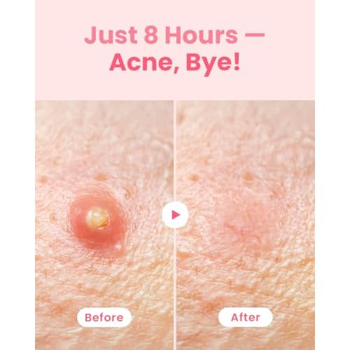 GLAM UP Hydrocolloid Blemish Pimple Zit Patches - Invisible Ultra Thin Spot Cover Stickers for Face and Skin, Strong Water-proof and Adhesive Overnight, Vegan-friendly (36 Count / 2 Sizes)
