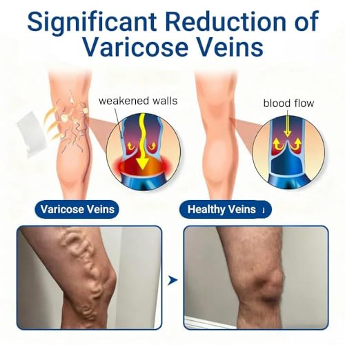 Varicose Veins Treatment Patches for Legs - 4 Cuttable Pcs
