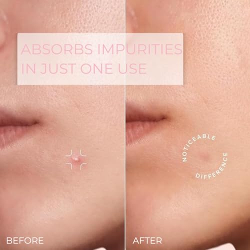 Pimple Patches ? Hydrocolloid Pimple Patch Spot Stickers for Acne and Whiteheads; Day or Nighttime Use; Fast Acting, Invisible Spot Treatment for Face and Skin- 72 Count