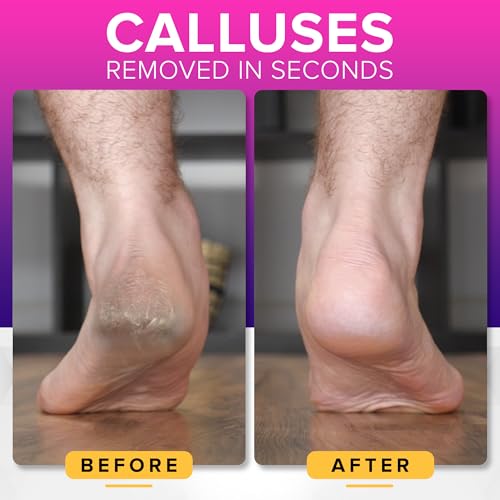NYK1 RUSTPROOF Foot File Callus Remover XL Size with Catcher - Pedicure Tool