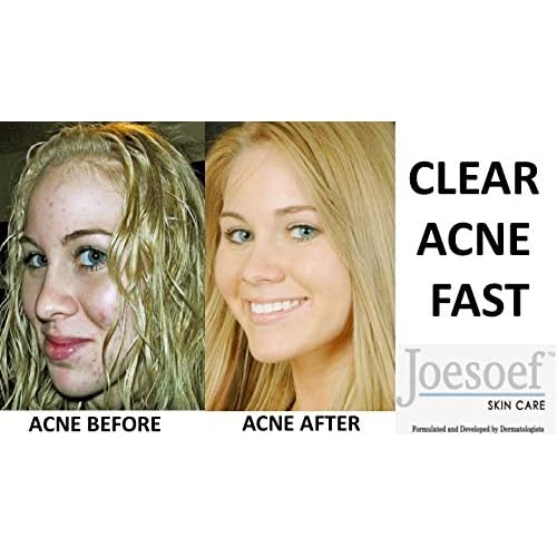 Joesoef Anti-Acne Soap, Natural Volcanic Sulfur 10%, for Oily to Normal Skin, 3.5-Ounces (Pack of 3)