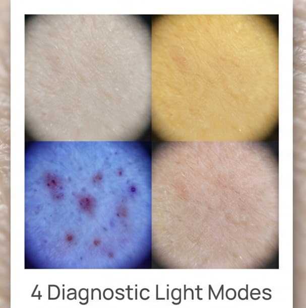 Portable Dermatoscope 30x Magnification with 4 Lighting Modes
