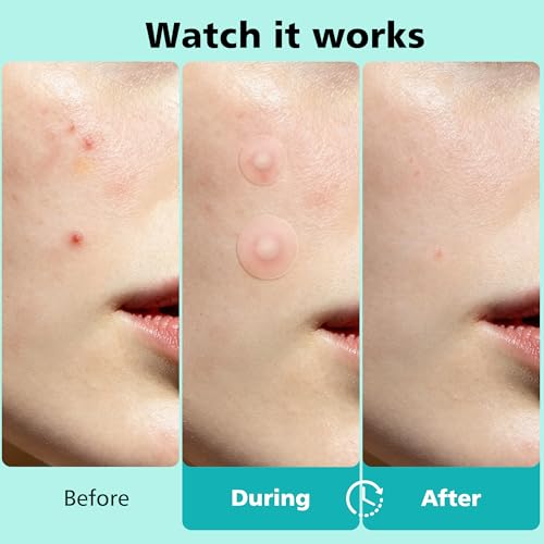 Dr.patch 563 Count Hydrocolloid Acne Patches for Face & Body - Invisible, Large & Small Sizes, Pack of 1
