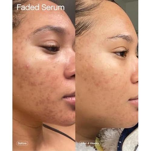 Topicals Faded Brightening and Clearing Serum | Reduces Discoloration, Post-Blemish Marks, Scars and Spots | Contains Kojic Acid and Niacinamide | Dermatologist-tested, Vegan, Cruelty-Free (1.7 Fl Oz)