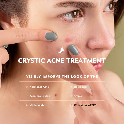Azelaic Acid Serum for Face Acne Treatment, Body Acne Clearing Treatment with 10% Azelaic Acid & Salicylic Acid, Sensitive Skin Care Facial Essential Cream for Recurring Breakouts Refine Pores 30ml