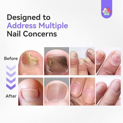 SAVILAND Toenail Fungus Pen Treatment 3-Pack with 25% Undecylenic Acid & 1% Tolnaftate