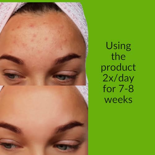 Xtracta Pore Control Serum for Acne-Prone Skin ? Salicylic Acid, Azelaic Acid, Colloidal Sulfur & Ginkgo ? Plant-Based Oil & Blackhead control, 30ml