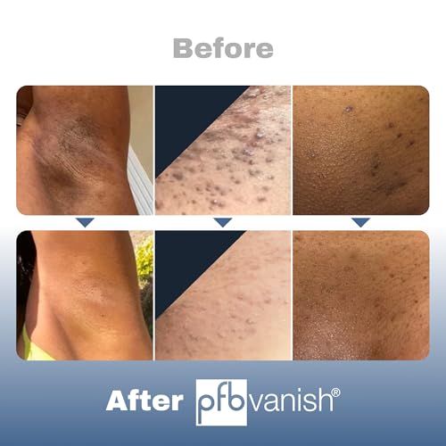 PFB Vanish Razor Bump Stopper Skin Care Treatment with Chromabright Dark Spot Remover, Roll On Formula Treats Ingrown Hairs and Razor Burns - 93g