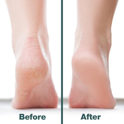 Probelle Double-Sided Nickel Foot File & Callus Remover - Pedicure Tool