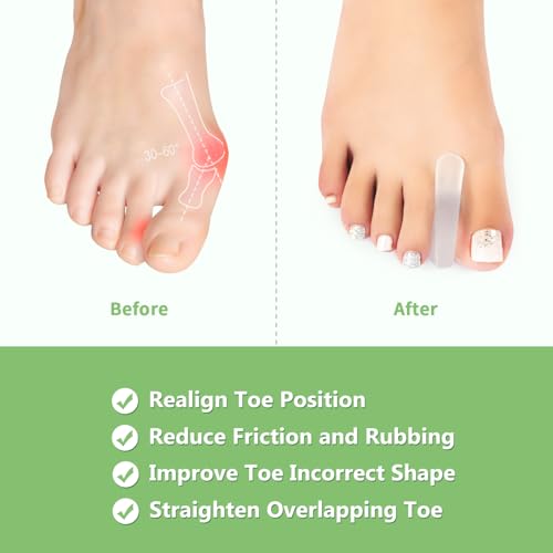 Silicone Toe Separator for Bunions, 10 Pack - Flared Design