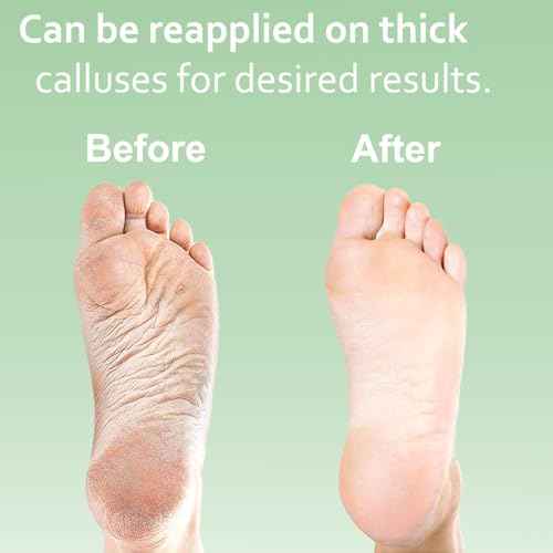 Dr. Entre's Callus Remover Gel: 8oz Extra Strength with Precision Applicator, Callus Remover for Feet, Foot Callus Remover, Foot Care, Pedicure Tools Supplies, Dead Skin Remover
