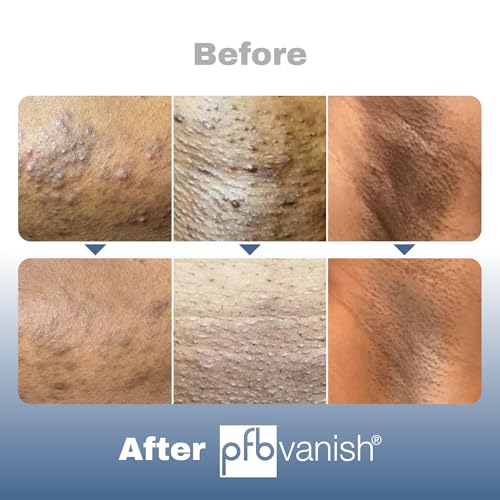 PFB Vanish Ultra Chromabright Ingrown Hair Treatment 6.56 oz - Dark Spot & Razor Bump Solution