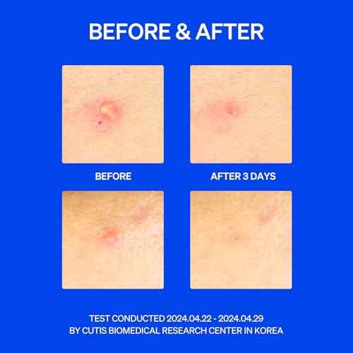 Right Away Thincognito Invisible Spot Patch - Absorbing Hydrocolloid Pimple Patch for Face, Blemishes, Zits, Acne, Breakouts Spot Treatment for Skin Care, 2 Sizes (42 Count Pack of 2)