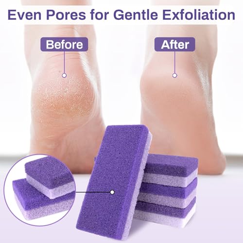 RAQEHO 10-Pack Dual-Sided Foot Pumice Stone for Callus & Hard Skin