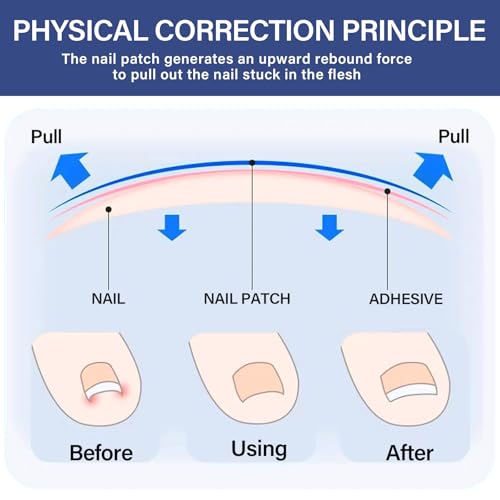 Ingrown Toenail Treatment-Patch(10pcs), Ingrown Toenail Corrector(Titanium Alloy), Ingrown Toenail Removal Kit, Cuttable Applicable for Any Nail Size, Nail Repair for Finger and Foot, Reusable