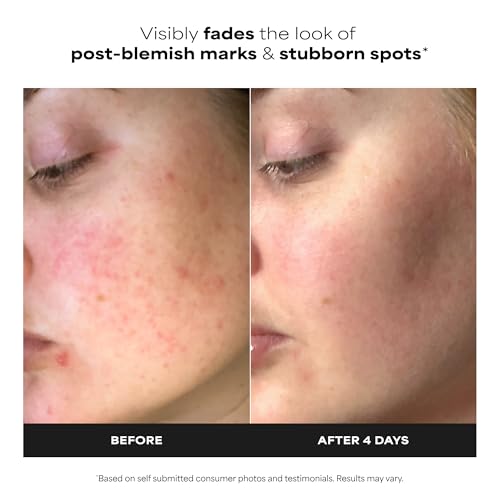 Paula's Choice 10% Azelaic Acid Serum - Acne & Spot Treatment