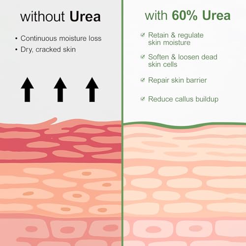 Urea Cream 60% with Salicylic Acid 2% - Dry Cracked Foot Repair Cream, 5.29oz