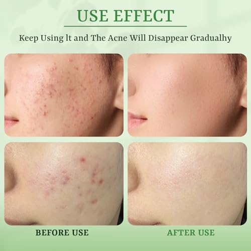 Anti Acne Face Mask Salicylic Acid Face Masks Skincare, Hydrating Face Masks, Soothing Facial Sheet Masks Skin Care for Acne Prone, Acne Mask for Pimple Breakouts Oil Control, 10 Pack