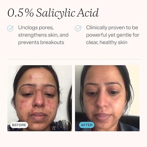 MDacne Hydrating Facial Cleanser with Salicylic Acid 0.5% - Acne Treatment with Plant-Based Ingredients to Remove Dirt & Oil, Protect Skin & Unclog Pores (2 Ounce (Pack of 1))