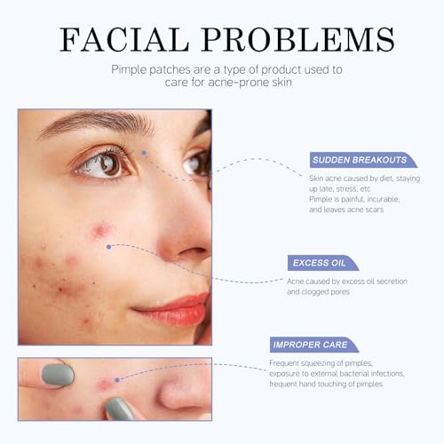 Acne Pimple Patches - 4 Sizes, 220 Count, Hydrocolloid Formula