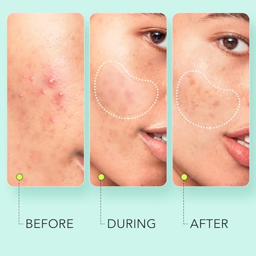 LitBear Large Pimple Patches (7 Sizes 306 Patches), Big Acne Patches, XL Hydrocolloid Bandages for Full Face, Forehead, Chin, Nose, Body, Back, Neck & Chest, Oval, Moon, Square hydrocolloid Patch