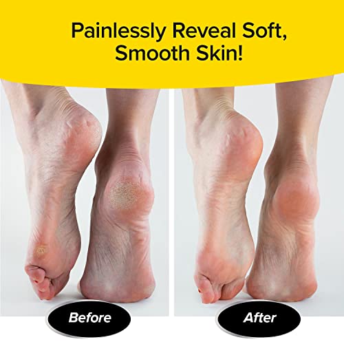 PedEgg Classic Foot File & Callus Remover - Mess-Free Exfoliating Tool