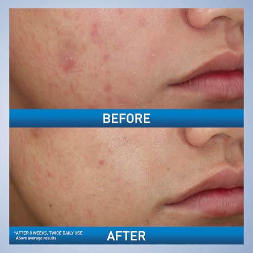 CeraVe Acne Foaming Cream Wash with 10% Benzoyl Peroxide