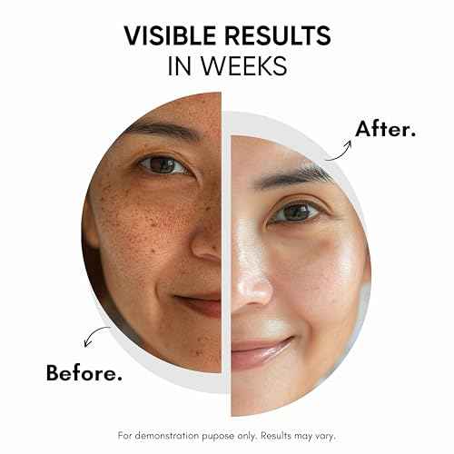 2% Kojic Acid Face & Body Cream for Pigmentation, Melasma, Acne Marks, Underarms, Neck - For Men & Women 30 ml (Pack of 1)