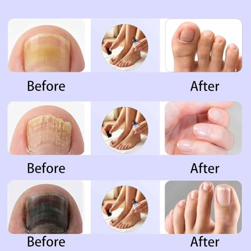 FOLUPIA Toenail Fungus Treatment with Tolnaftate – Extra Strength Nail Repair Serum 1 Fl Oz