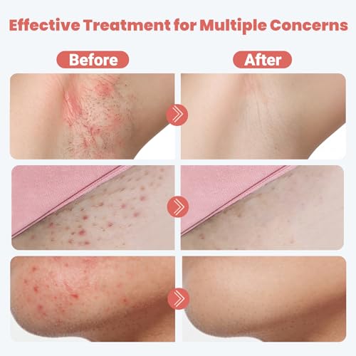 Ingrown Hair Treatment Pads - Salicylic & Glycolic Acid, 60 Pads