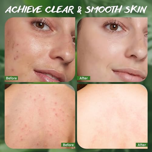 Tea Tree Oil Soap Bar for Face & Body Wash All Natural Organic Bath Soaps Acne Hand Foot Body Oder Moisturizer Plant Deodorant Facial Cleanser Women Men with Soap Holder Bag Scrubber Mesh