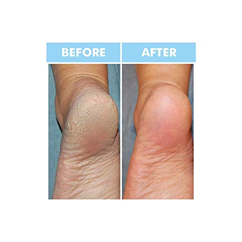 Bodipure Keratin Hand and Foot Mask Combo Set for Dry, Calloused Skin