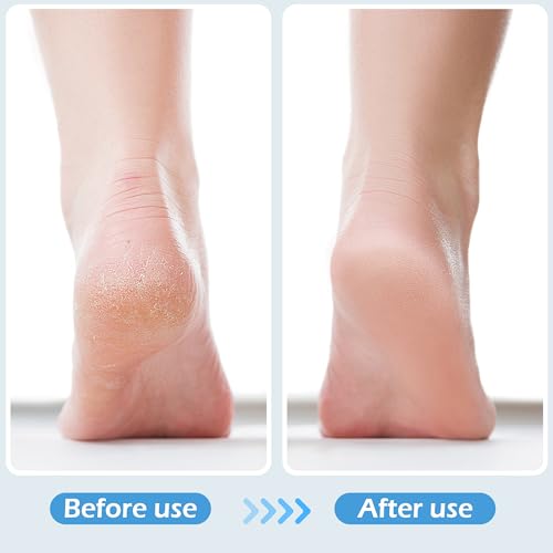 4-in-1 Foot Scrubber Brush & Callus Remover - Pumice Stone Set (3 Pack)