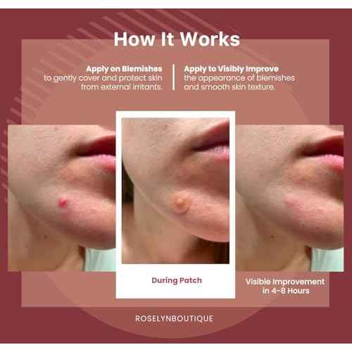 ROSELYNBOUTIQUE Pimple Patches for Face - Hydrocolloid Acne Patches with Tea Tree Oil, Zits Blemishes Pore Strips - Vegan Facial Skin Care Products Cruelty-Free (150 Counts - 4 Sizes)