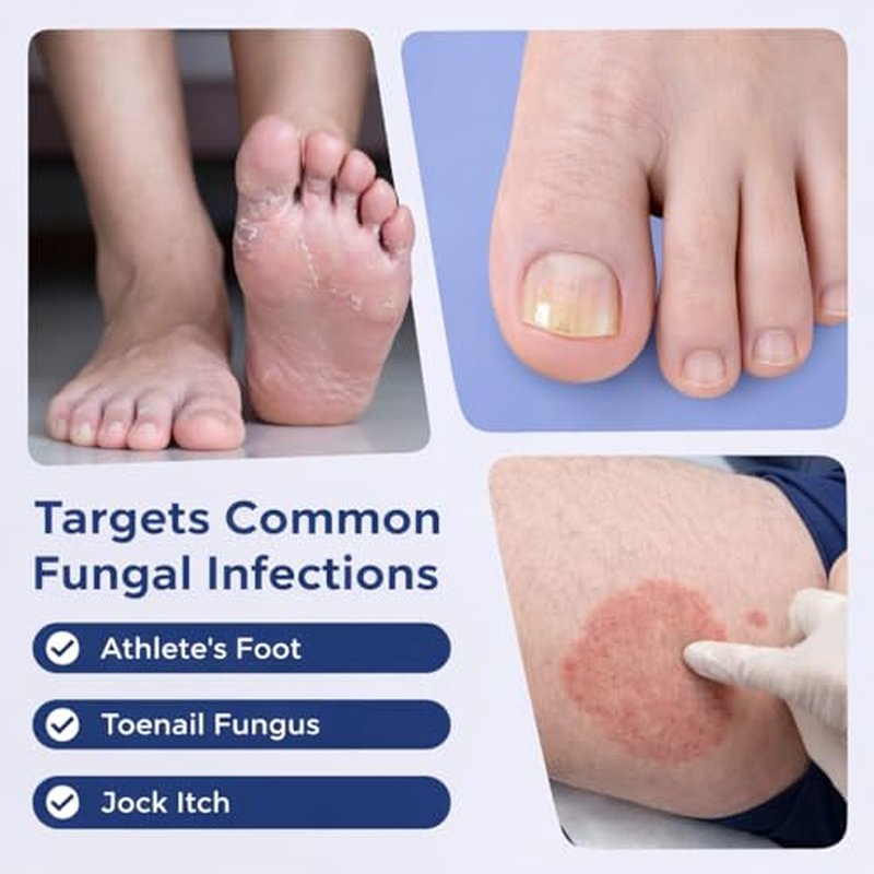 Toenail Fungus Treatment Pen – 25% Undecylenic Acid FSA Eligible