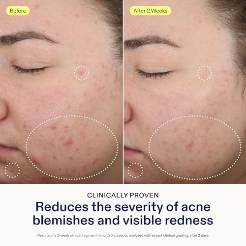 Skinfix 2% BHA Spot Treatment - 0.5 fl oz - Clears Acne Blemishes & Blackheads with Niacinamide - Fragrance Free - Vegan, Cruelty Free