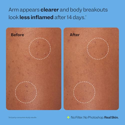 Peach Slices - Body Breakout Patches (6 ct) - Overnight Body Pimple Patches - Hypoallergenic - Flexible & Painless - Cica & Hydrocolloid Bandages - Vegan & Cruelty Free - Korean Skin Care & Beauty