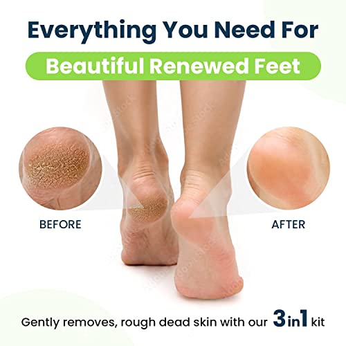 Callus Remover for Feet with Extra Strength Gel & Foot Pumice Stone Set - Easy Way to Remove Hard Calluses & Dead Skin & Tea Tree Oil Foot Balm/Moisturizer for Dry Cracked Feet