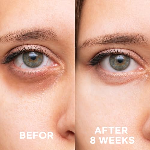Epielle Brightening Eye Cream | Anti-Aging Serum for Dark Circles & Wrinkles | Cooling Applicator for Refreshing Application | Korean Skincare