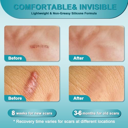 Scar Cream, Advanced Scar Gel for Old & New Scars, Professional Scar Removal Cream For Surgical Scars, Face, Body, Leg, Acne, Stitches, Burns, C-Section, Keloids, 1.76oz