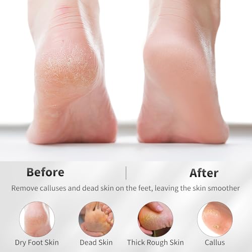 ÖkoStamm 4-Piece Natural Volcanic Pumice Stone Set for Feet Callus Removal