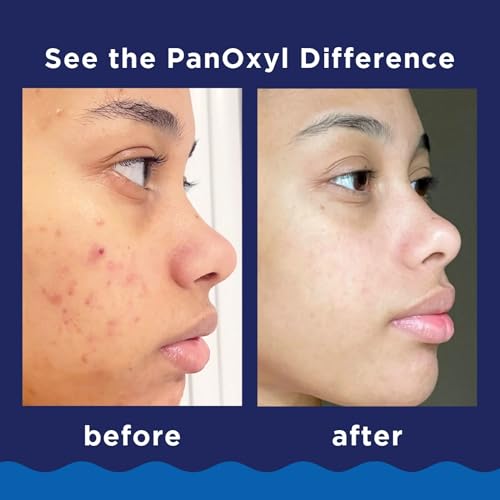 PanOxyl Foaming Acne Wash Maximum Strength 5.5 oz (Pack of 6)