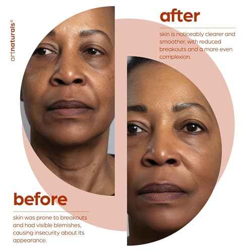 artnaturals Salicylic acid Serum - Advanced Serum with 2% BHA - Helps control oil production- Pore Reducer - 1 oz