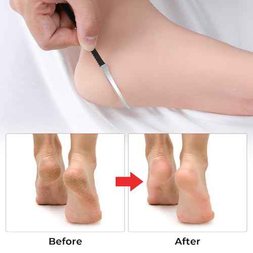 6Pcs Professional Pedicure Knife Kits, Stainless Steel Nail Knives Cuticle Remover Dead Skin Corn Foot Callus Remover Foot Care Tools for Home Beauty Salon