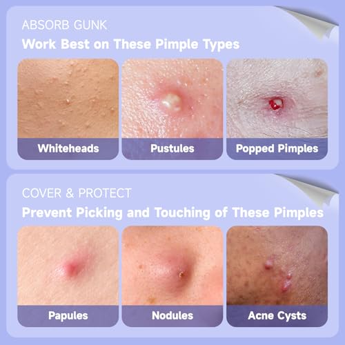 Dazzlook 36 Pack Ultra Pimple Patches Variety Set with Salicylic Acid - Discreet Acne Spot Covers for Face & Skin