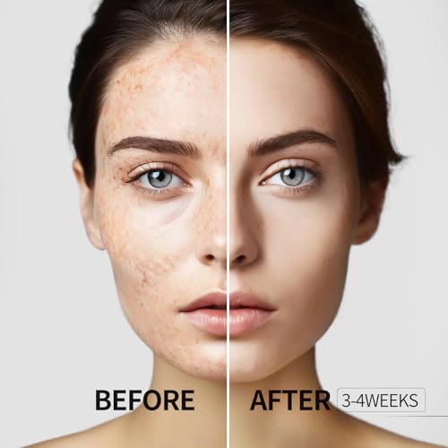 HANYWIL Dark Spot Corrector Serum with Vitamin C & Roller