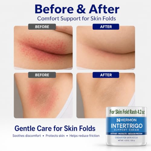 Hermon Intertrigo Cream for Skin Folds with Zinc Oxide - Chafing & Moisture Support, 4.2 oz