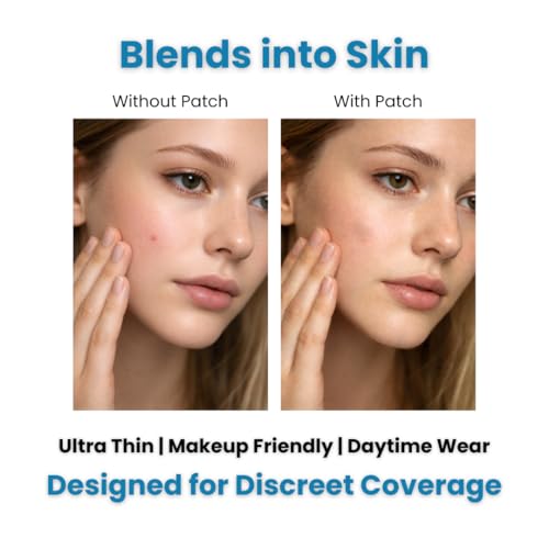 Medical Miracles Acne Patches Hydrocolloid Blemish Spot Covers ? Invisible Pimple Patches for Face, Absorbing Protective Stickers, Day & Night Coverage, Drug-Free Skincare (Pack of 72)