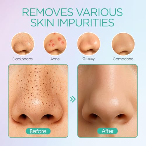 VOYOR Blackhead Remover Pore Vacuum - 6 Heads, 3 Modes