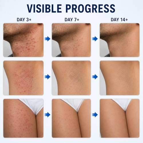Folliculitis Treatment Cream for Razor Bumps & Ingrown Hairs